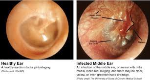 Pin By Kayley Lewis On Nursing Middle Ear Middle Ear Infection Symptoms Ear Infection Symptoms