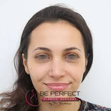 Am făcut acesta operație sub anestezie. Rinoplastia Corectia Nasului Pret Operatie Recuperare In Bucuresti