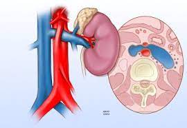 Renal Nutcracker Syndrome Surgical Options Sciencedirect