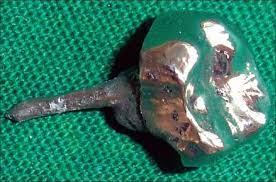 We did not find results for: Restoration Of Badly Broken Endodontically Treated Posterior Teeth Abstract Europe Pmc
