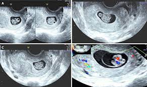 Maybe you would like to learn more about one of these? Early Ultrasound Diagnosis Of Conjoined Twins At Eight Weeks Of Pregnancy A Case Report
