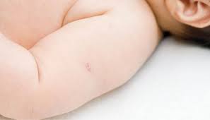 Studies of the effectiveness of bcg vaccine must be administered intradermally, normally into the lateral aspect of the left upper arm. Saude