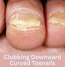 Image result for Clubbing nails feet
