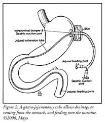 Choosing The Right Tube For You Oley Foundation