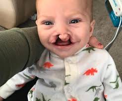 Mum of clef-lip-and-palate baby gets a kind surprise