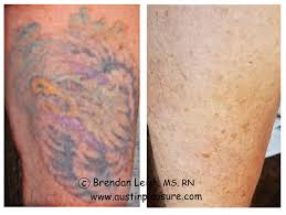 For more images and information about my tattoo laser removal sessions, visit my website, where i take you through each of of my 18 treatments since 2013. Before After Photos Austinpicosure Com A Tattoo Removal Nurse S Notes