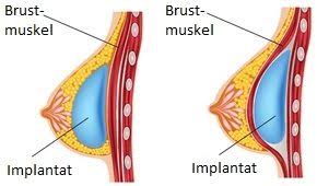 Es kann von einer isolierten hypoplasie bzw. Stillen Nach Brustvergrosserung Und Brustverkleinerung Still Lexikon