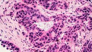 Unlike normal blood cells, leukemia cells don't die when they should. Breast Cancer Linked To Bone Marrow Cells Nfcr