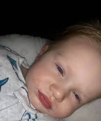 Asher is now three years old, but these pictures are from his first year of  life. His skin has good days and bad days. It appears darker red when he is  warm,