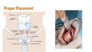 Tracheostomy Care And Management