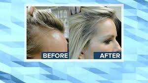 Androgenetic alopecia new treatment options have recently been introduced for men and women with aga. New Treatment Offers Hope For Women With Hair Loss Abc News