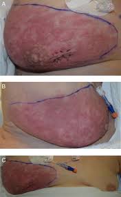 Image result for Inflammatory breast cancer