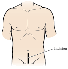 About Your Prostate Surgery Memorial Sloan Kettering Cancer Center