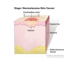 The first two are the most common, and the third is the most dangerous. Cancerhelp Online Nci Cancer Diagnosis And Treatment