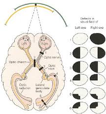 Visual Field Deficits Produced By Lesions At Various Points