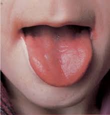 A condition that is marked especially by the growth of a mucous membrane across the esophageal lumen, by difficulty in swallowing, and by hypochromic anemia and that is usually considered to be due to an iron deficiency. Plummer Vinson Syndrome Dysphagia Iron Deficiency Dr Thind