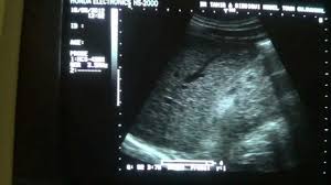 Diffuse Renal Parenchymal Diseases | Radiology Key