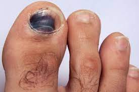 Las infecciones por hongos en las uñas se producen debido a diversos organismos fúngicos (hongos). Como Curar Una Una Negra Del Pie