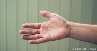 Hand Fuss Mund Krankheit Ansteckung Symptome Behandlung Netdoktor