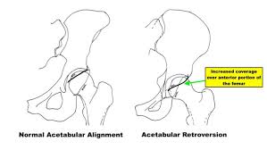 Image result for Femoral Retroversion