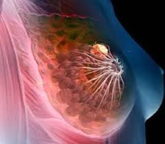 What does a cancerous breast lump feel like? What Exactly Do I Need To Know About Breast Cancer Check Your Boobs