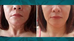 Red Light Therapy Offers Full Body Benefits Without Side Effects Youtube
