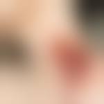 Image result for Human Bite