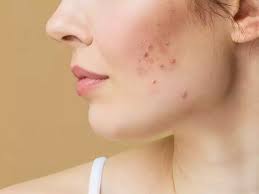 If you are not getting rid of pimples then follow these tips you will get  glowing skin| पिंपल्स से नही छुट रहा है पीछा तो फोलों करें ये टिप्‍स,  मिलेगी ग्‍लोइंग स्किन