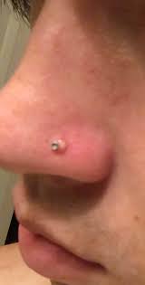 Need Help Nose Piercing Bump Keeps Coming Back And Filling With Pus I Ve Tried Using Saline But It Just Won T Go Away It Piercing