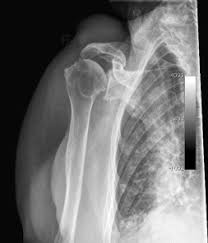 Wiederholte mikrotraumata bei internen impingementformen: Arthrosen Acg Luxationen Chronische Instabilitat Sciencedirect