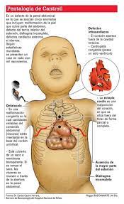 Patología del corazón fuera del pecho 
