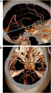 We did not find results for: Relationship Of The Angle Between The A1 And A2 Segments Of The Anterior Cerebral Artery With Formation And Rupture Of Anterior Communicating Artery Aneurysm Journal Of The Neurological Sciences