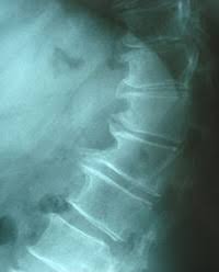Spondylosis Deformans Wikipedia
