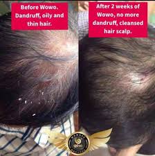 You can experience psoriasis anywhere on your body, but it can be especially harsh on the scalp because itching it can lead to hair loss or damage. Beauty Paradise Itchy Scalp Oily Scalp Flaky Scalp Facebook