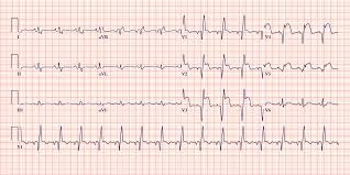 Patients may have elevated blood levels of markers of myocardial necrosis (the markers may also be elevated in ua, but in such cases they do. Ecgs In Acute Myocardial Infarction Acls Medical Training