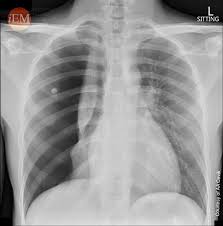 Image result for Pneumothorax