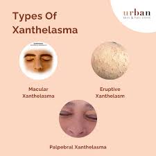 Image result for xanthelasma of eyelid