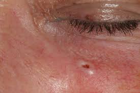 Sometimes lentigo maligna and actinic lentigo may have clinically the same characteristics: Skin Lesions Intechopen