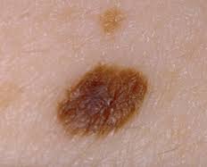 View more melanoma pictures here. The Signs Of Skin Cancer Cancer Council Nsw