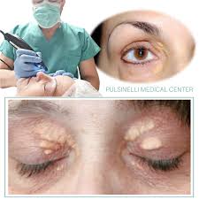 Image result for xantelasma
