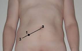 Appendizitis Alles Uber Die Blinddarmentzundung Wurmfortsatz