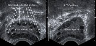 This can lead people to think their cycles or symptoms are normal when they might not be. Das Pco Syndrom Symptome Ursachen Und Behandlungsmoglichkeiten