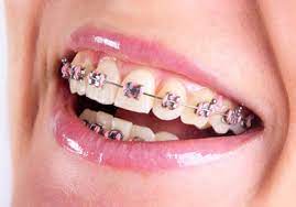 Gold braces on dark skin. Choose Your Braces Southern Smile Orthodontics