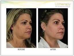 How does Ellacor microcoring technology work for skin tightening, and what  kind of results can I expect?