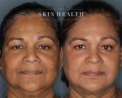 A ⭐️transformation⭐️ that's truly ageless. . This beauty embarked upon a  journey with us using ZO SkinHealth topicals and the results speak for  themselves: soft, glowing, youthful, healthy skin 🤩✨ . . . #