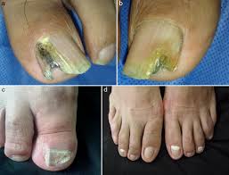 Image result for onychomycosis