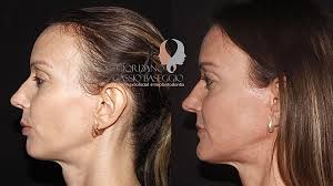 Giordano Baseggio Buco Maxilo Facial (@giordanobaseggio) • Instagram photos  and videos