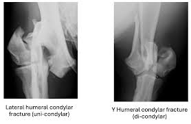 Image result for Lateral Condyle Fracture
