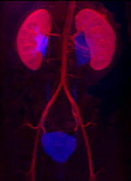 A vcug is usually done if Vesicoureteral Reflux Vur Pediatric Urologists Georgia Urology