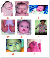 All respiratory diseases have unpleasant symptoms and dangerous consequences. Fig A Is Anencephaly Fig B And C Is Down S Syndrome Fig D Is Club Foot Download Scientific Diagram